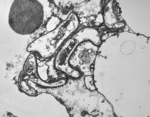 M,50y. | Pneumocystis carinii - lung